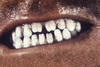 This image depicts the dentition of a congenital syphilis patient, who due to this disease, went on to develop what are known as Hutchinson&rsquo;s teeth, in which case the teeth are widely spaced, and the bite surfaces of the incisors are notched.