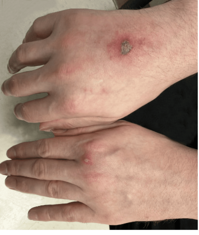 Figure 1 - Pustular Rash on Hands