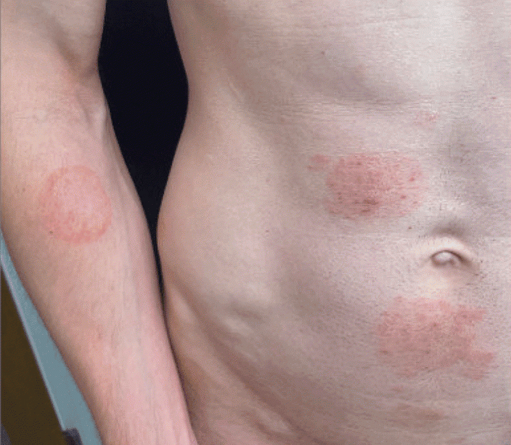 Figure 1 - Annular Scaling Rash
